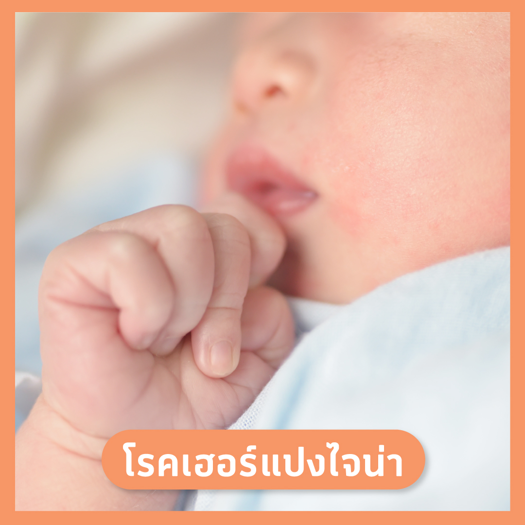 เฮอร์แปงไจน่า