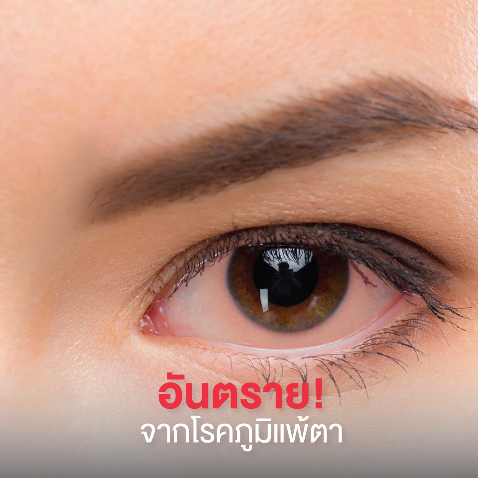 Allergic Pink Eye