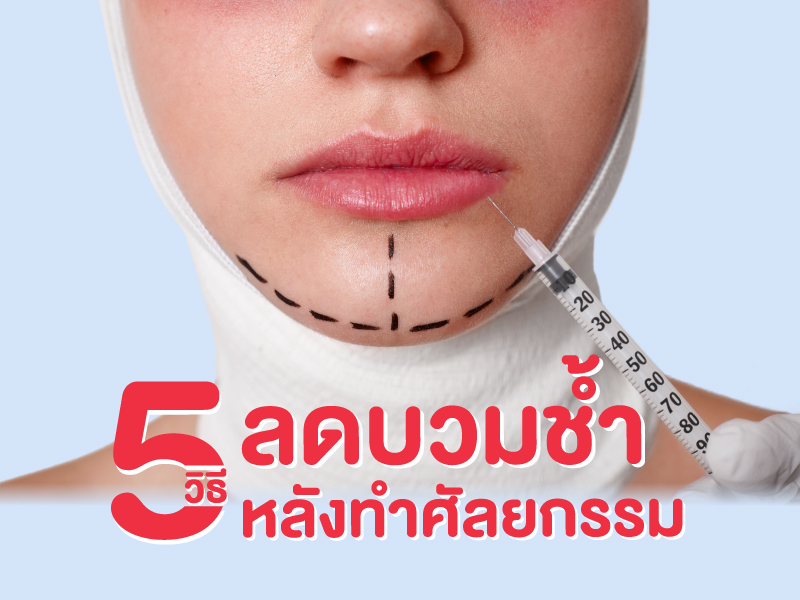 5 วิธีลดอาการบวมช้ำ หลังทำศัลยกรรม 
