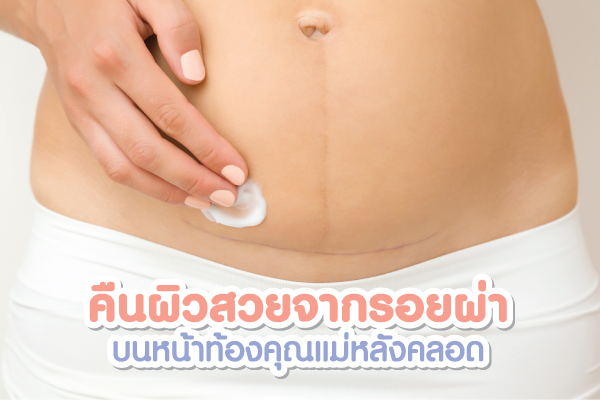 คืนผิวสวยจากรอยผ่าตัดหลังคลอด