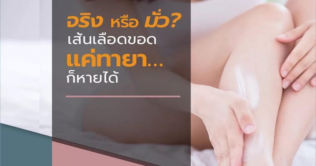 เส้นเลือดขอด