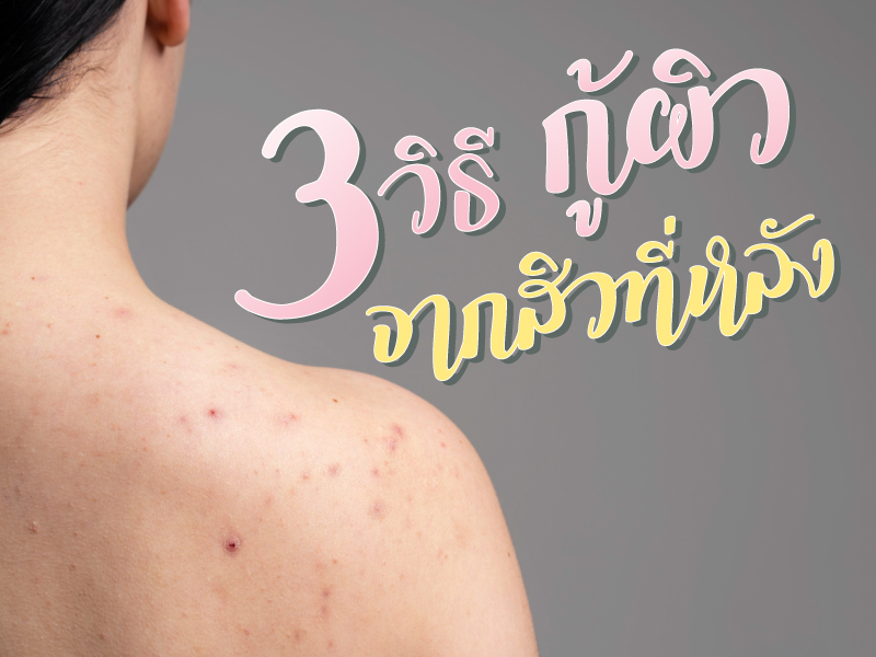 back acne treatment