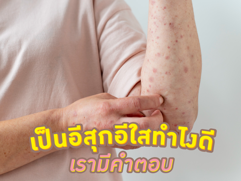 เป็นโรคอีสุกอีใสทำยังไงดี เรามีคำตอบ 