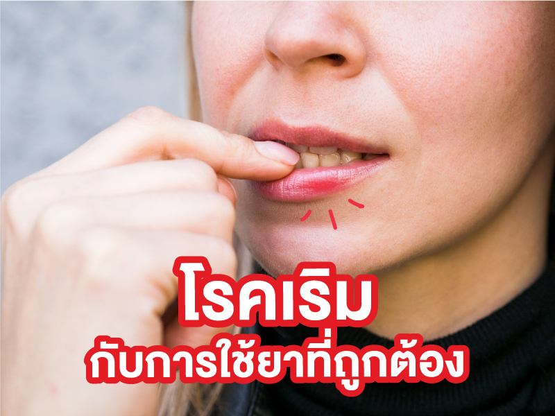 คำถามยอดฮิต โรคเริมกับการรักษาและการใช้ยาที่ถูกต้อง