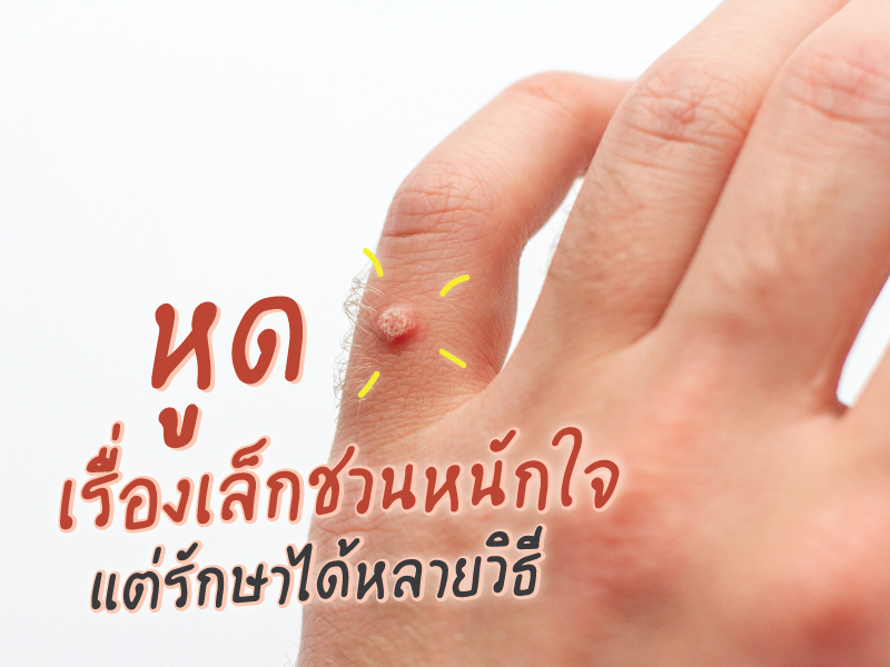 หูด เรื่องเล็กชวนหนักใจ รักษาได้หลายวิธี