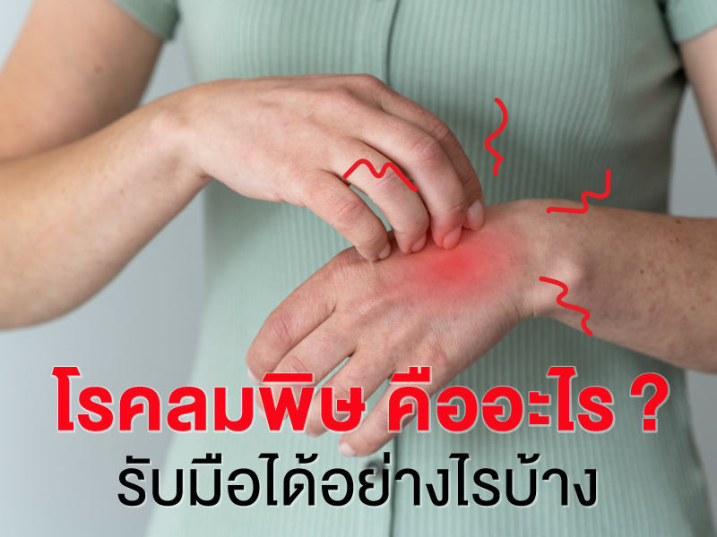 โรคลมพิษ
